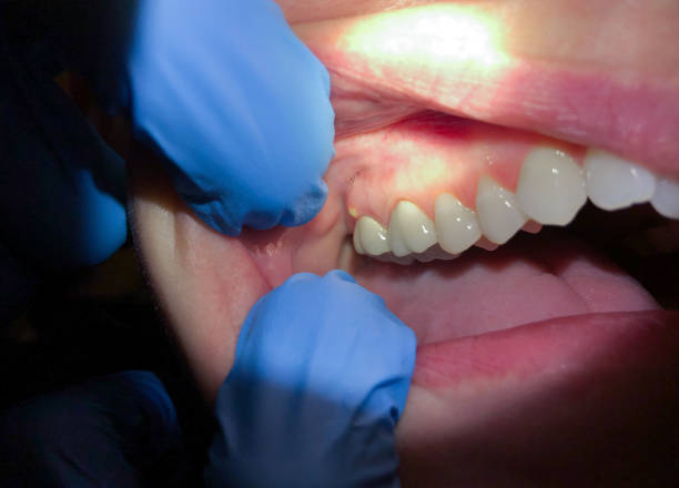 Best Emergency Tooth Extraction in Centre Grove, NJ